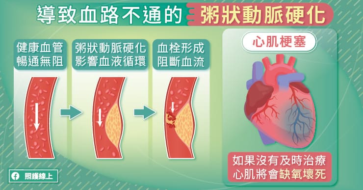 血栓形成導致動脈粥狀動脈硬化