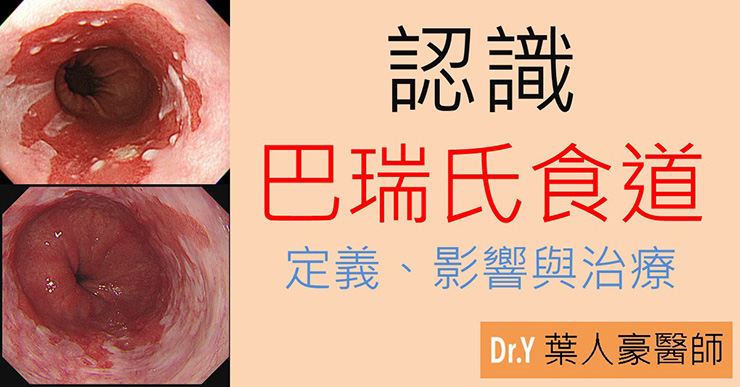 食道逆流會變癌？認識巴瑞氏食道