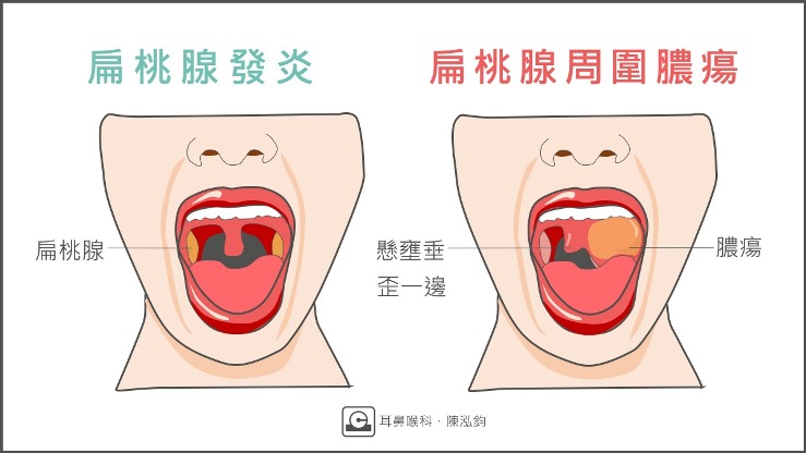 扁桃腺「周圍膿瘍」跟扁桃腺「化膿」