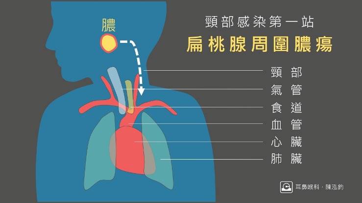 扁桃腺周圍膿瘍是深頸部感染的第一站