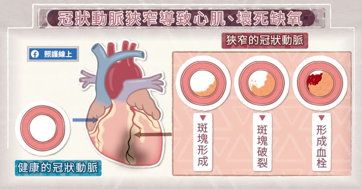 冠狀動脈狹窄，導致心肌缺氧壞死