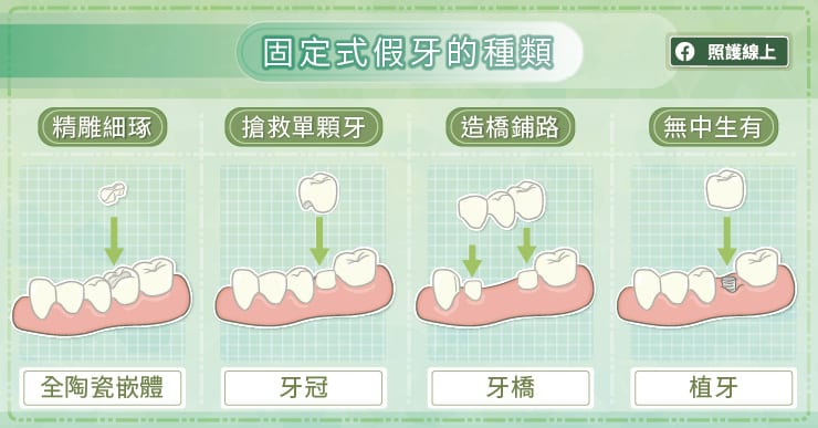 固定式假牙的種類