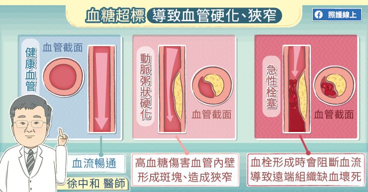 血糖超標導致血管硬化、狹窄