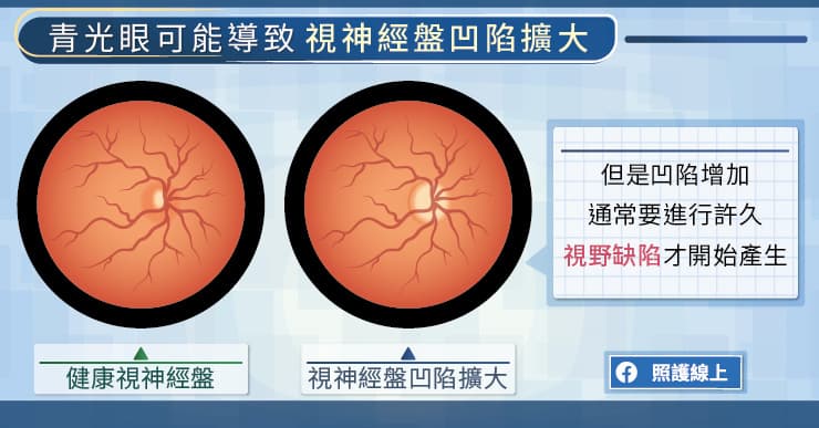 青光眼可能導致視神經盤的凹陷擴大