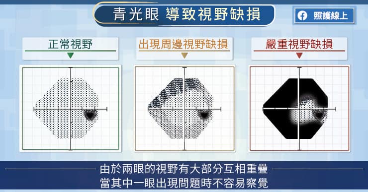 青光眼導致視野缺損