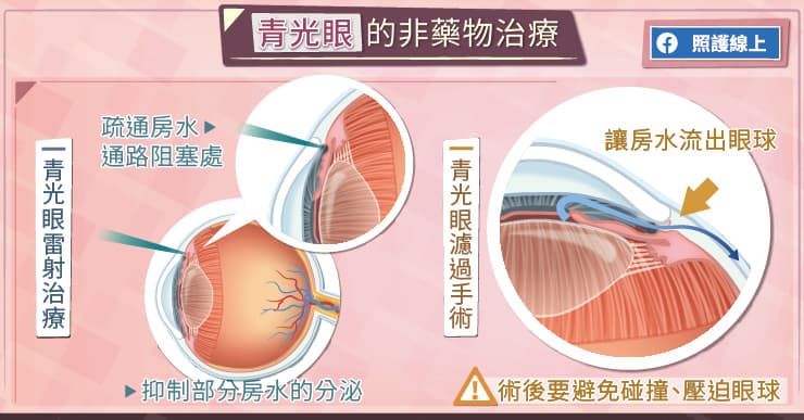 青光眼的非藥物治療