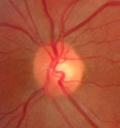 可能失明！青光眼的危險因子，你中了幾個？