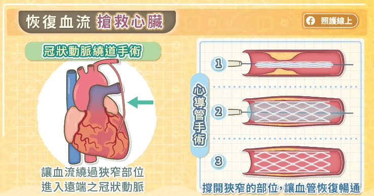 恢復血流搶救心臟