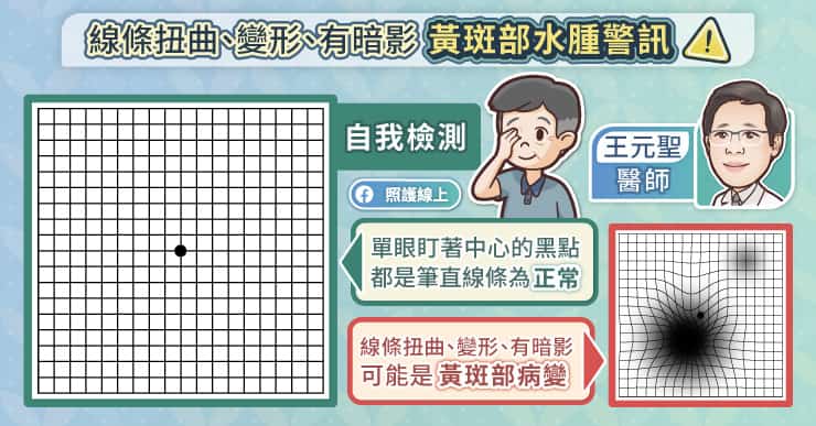 所扭曲、變形、暗影黃斑部水腫警訊