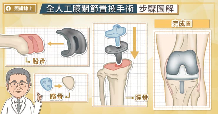 人工關節置換手術的進化