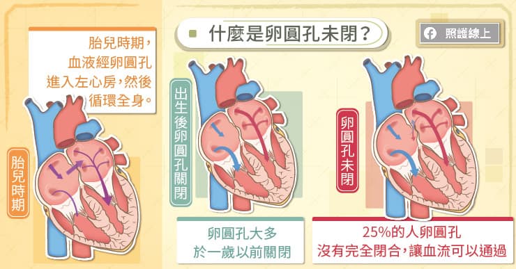 什麼是卵圓孔未閉？