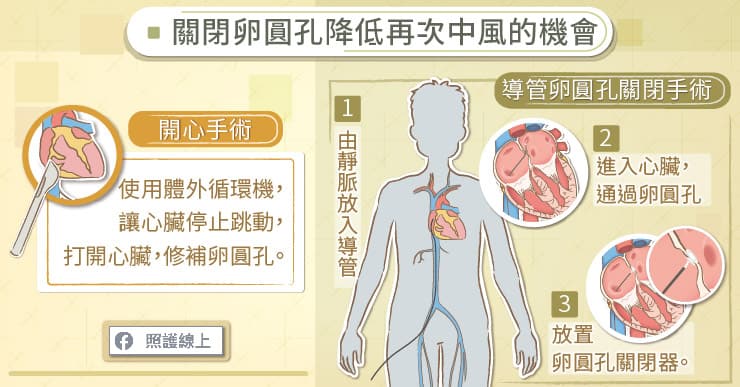 關閉卵圓孔，減少二度中風的機會