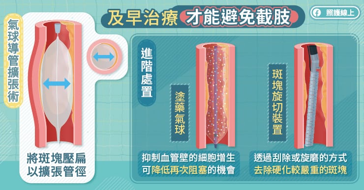 及早治療才能避免截肢