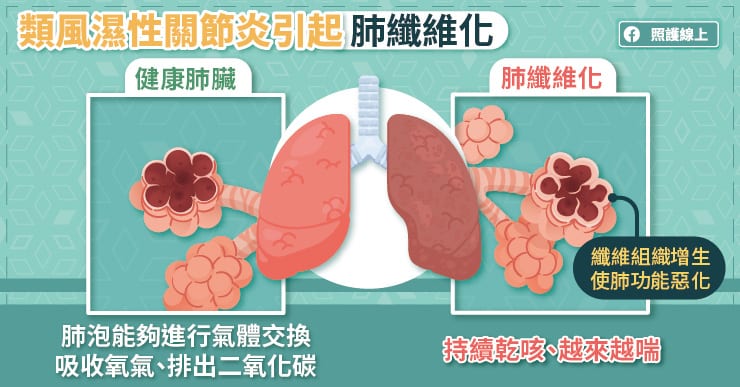 類風濕性關節炎引起肺纖維化