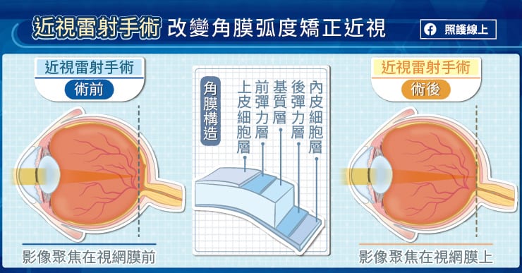近視雷射手術改變角膜弧度矯正近視