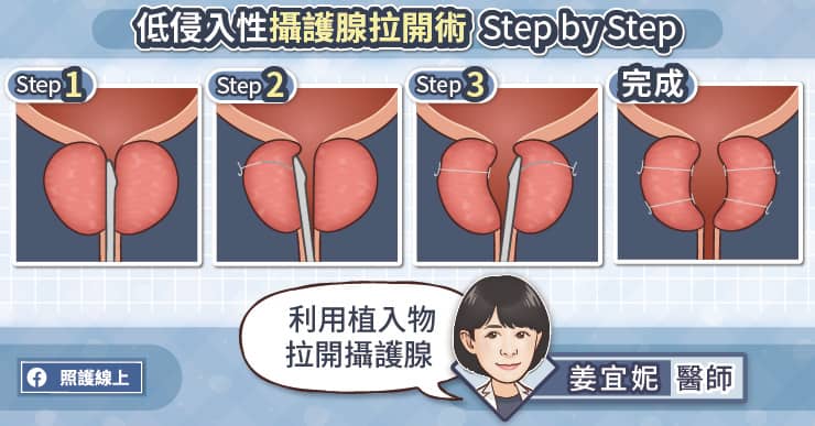 低侵入性攝護腺拉開術