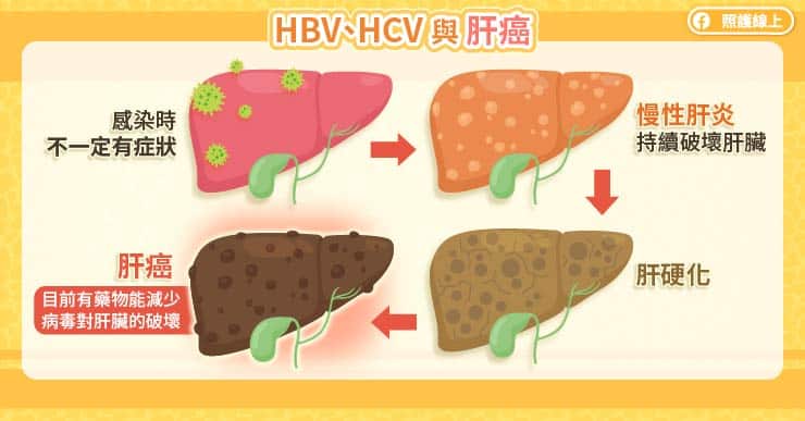 HBV、HCV與肝癌