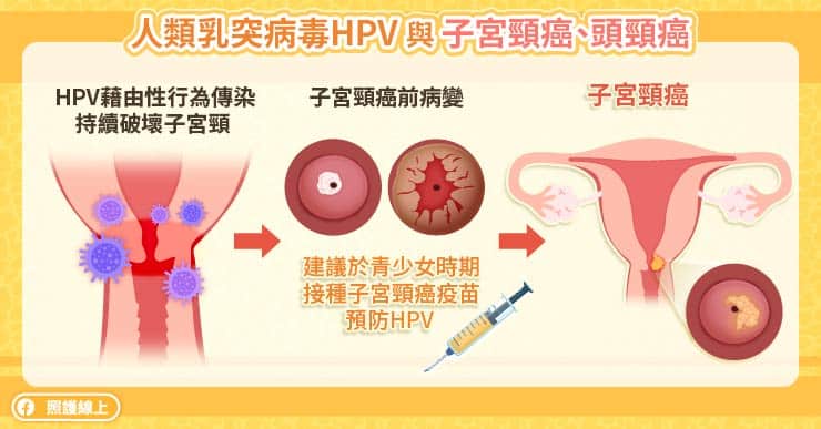 HPV與子宮頸癌、頭頸癌