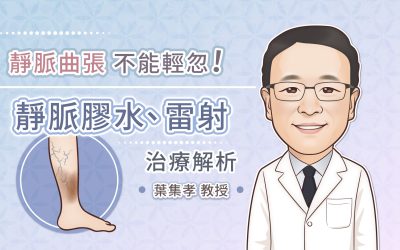 靜脈曲張不能輕忽！靜脈膠水、雷射治療解析