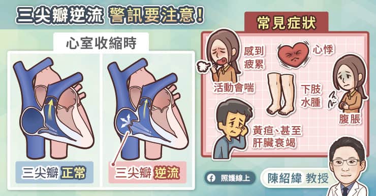 三尖瓣逆流警訊
