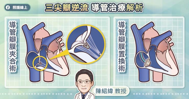 三尖瓣逆流導管治療