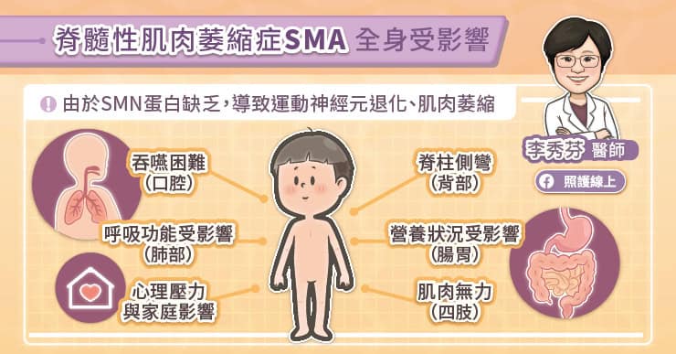 脊髓性肌肉萎縮症（SMA）全身受影響