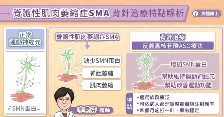 脊髓性肌肉萎縮症（SMA）背針治療