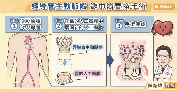 經導管主動脈瓣「瓣中瓣置換手術」