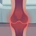 關節痛到懷疑人生？你可能不知道的痛風真相！