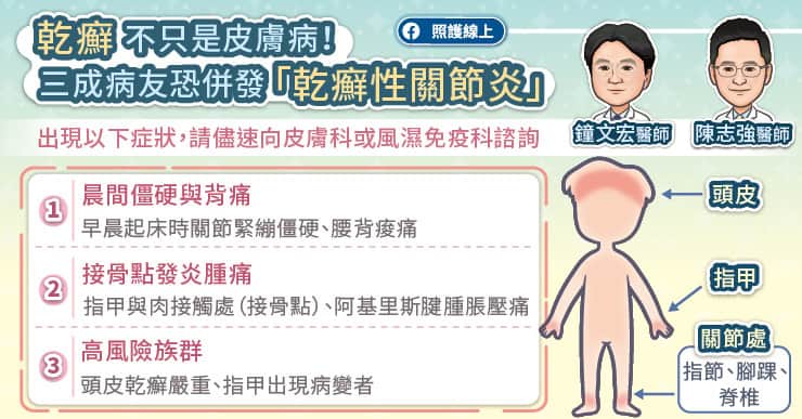 乾癬不只是皮膚病!約3成病友恐併發「乾癬性關節炎」
