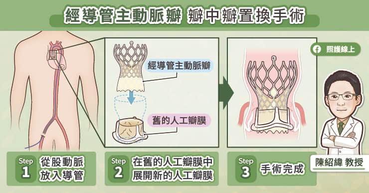 經導管主動脈瓣 瓣中瓣置換手術