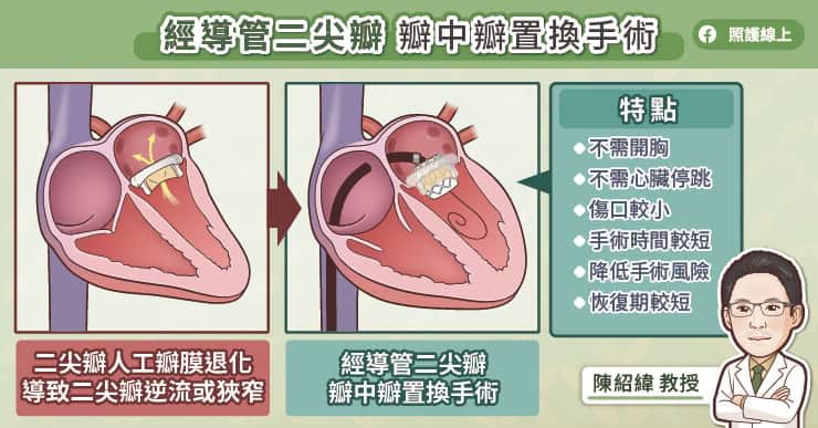 經導管二尖瓣 瓣中瓣置換手術